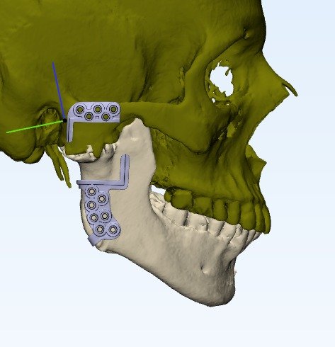 TMJ Replacement