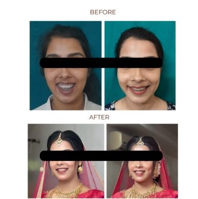 Maxillary Prognathism(Upper Jaw Deformity)