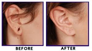 Ear Construction