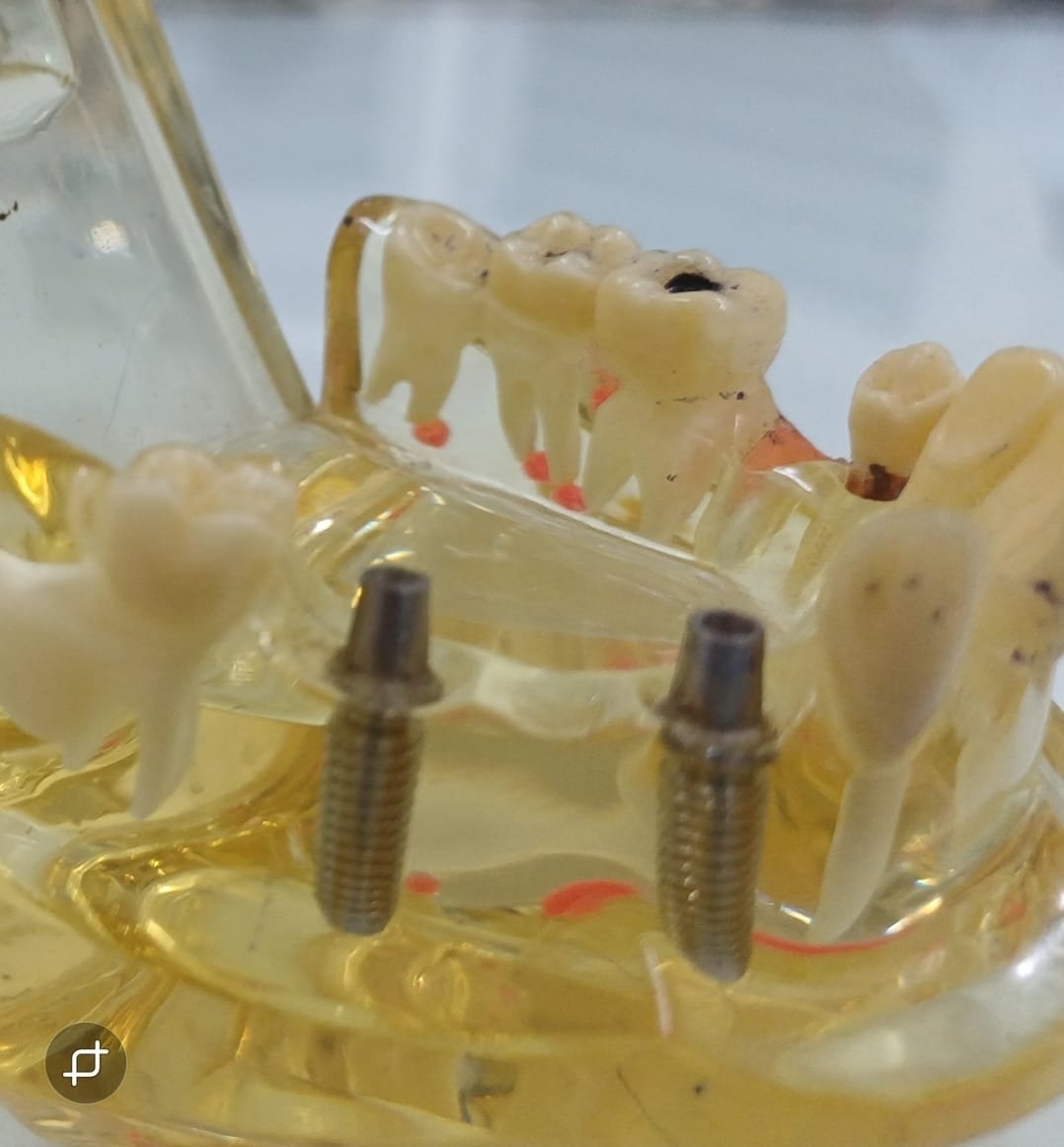 Fixed Denture