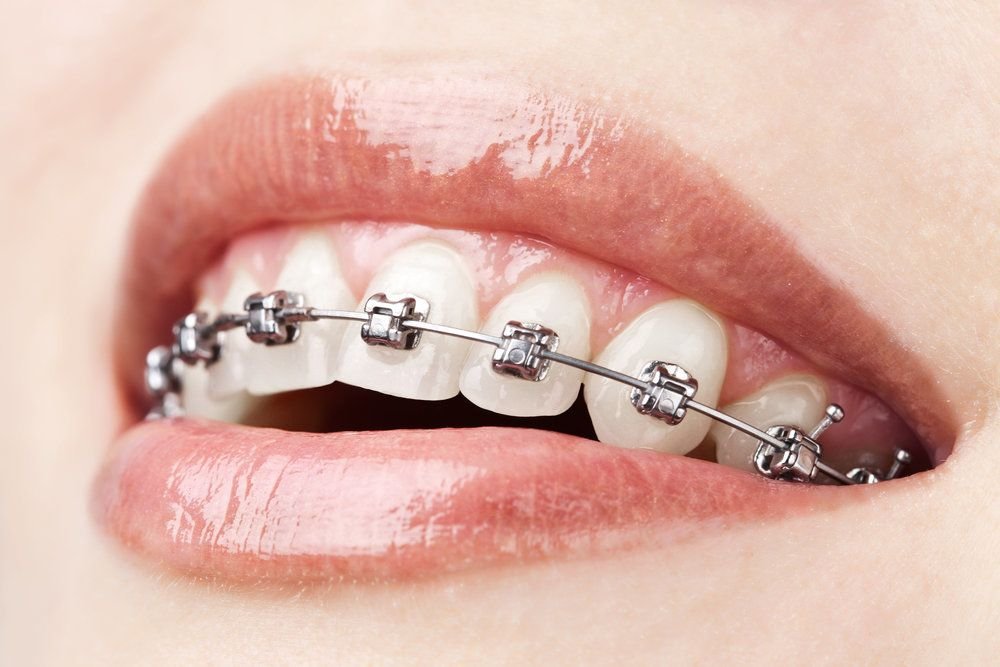 Fixed Orthodontics