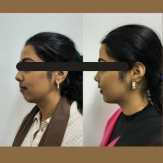 Maxillary Prognathism(Upper Jaw Deformity)