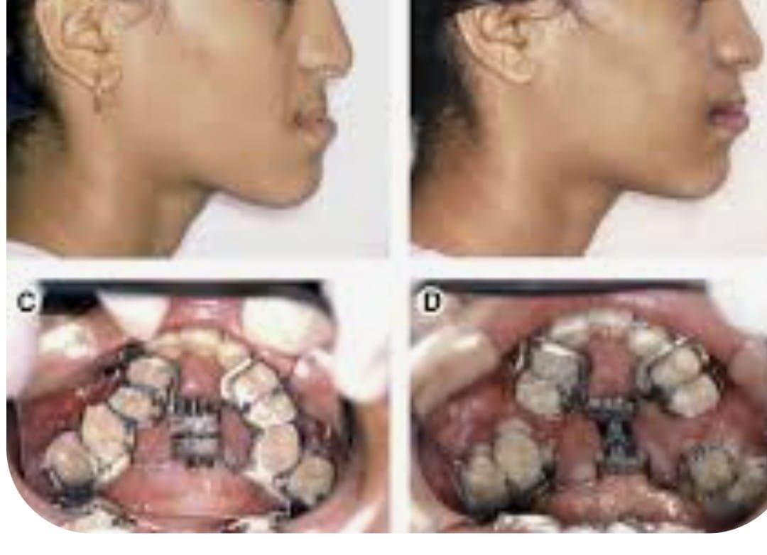 Deficient Mandible