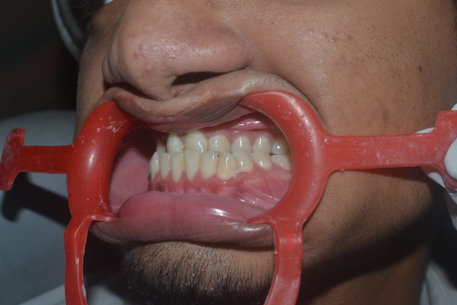 Mandibular Jaw Orthognathic Surgery