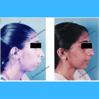 Deficient Mandible