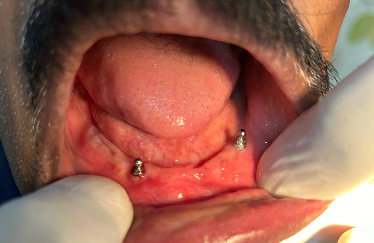 Dental Implants