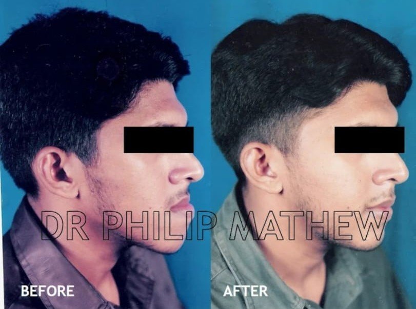 Mandibular Jaw Orthognathic Surgery