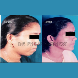 Jaw Contouring / Jaw Repair