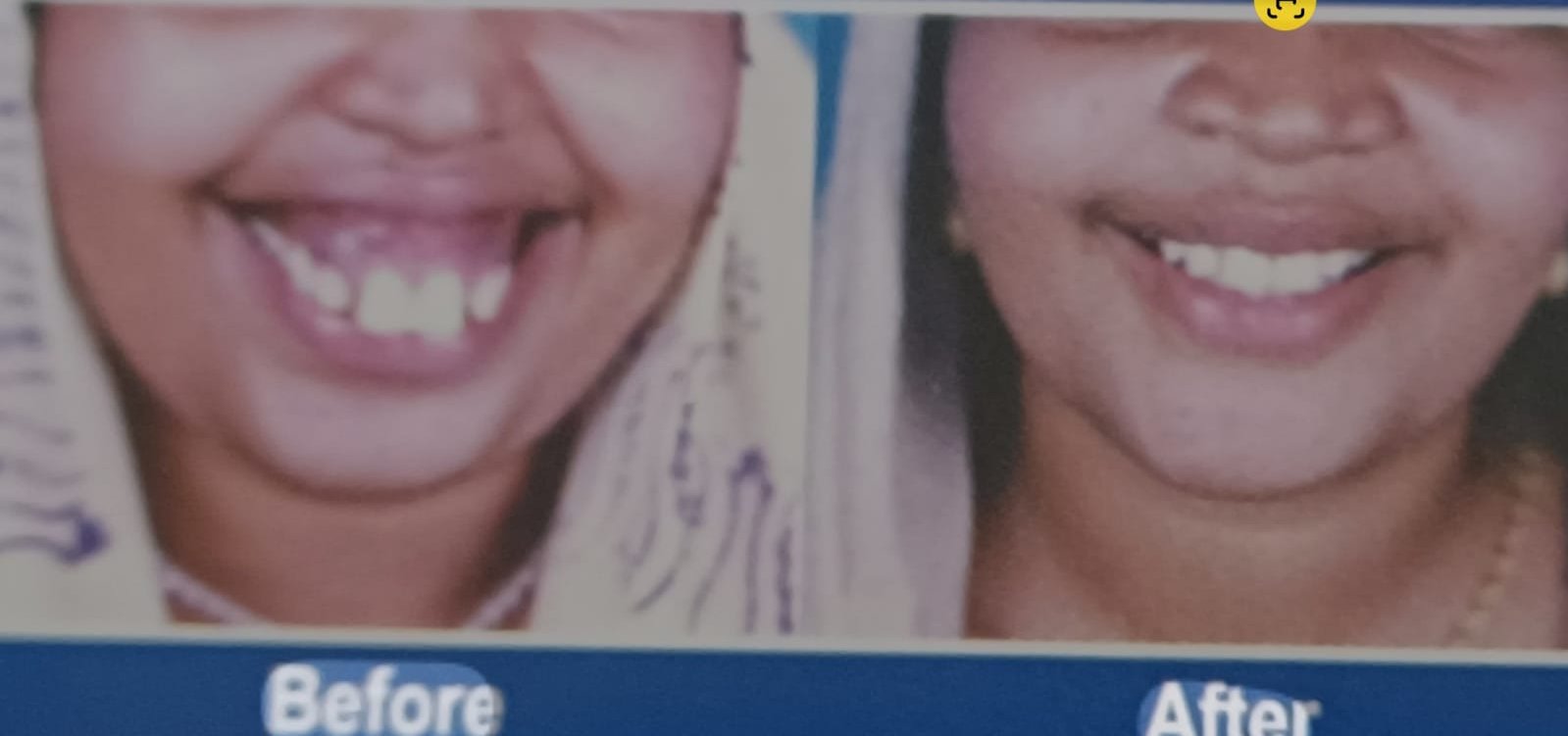 Maxillary Prognathism(Upper Jaw Deformity)