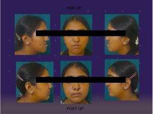 Mandibular Jaw Orthognathic Surgery