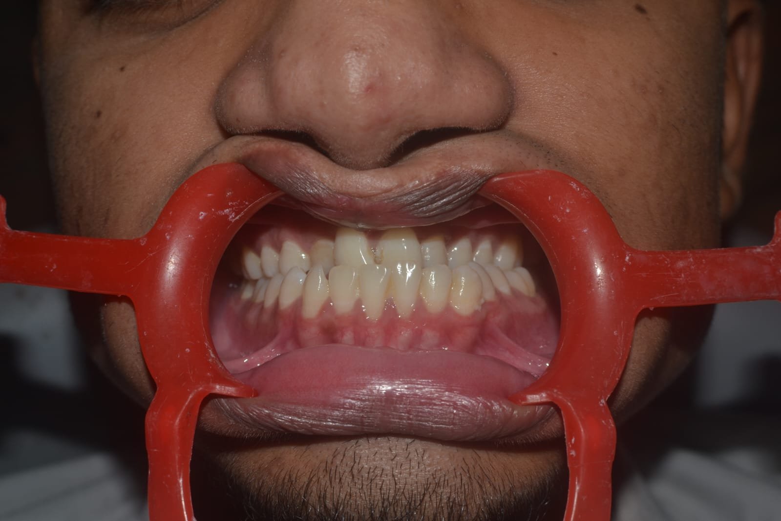 Mandibular Jaw Orthognathic Surgery