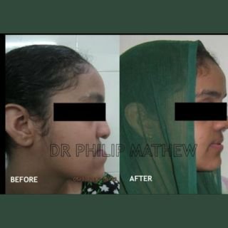 Mandibular Jaw Orthognathic Surgery