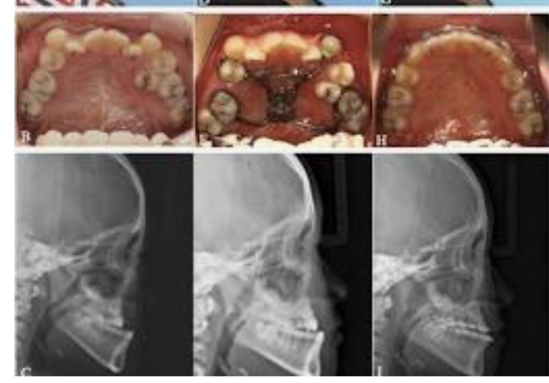 Maxillary Hypoplasia