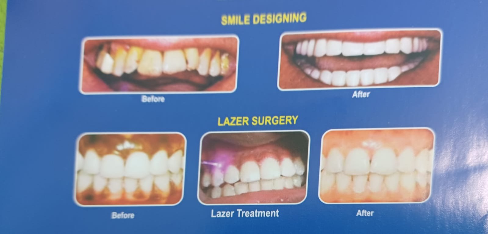 Smile Design