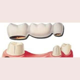 Fixed Denture