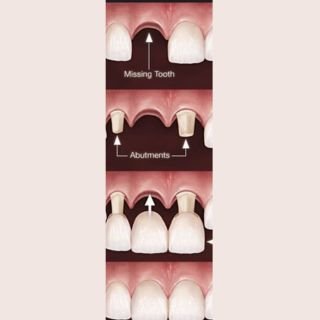 Fixed Denture