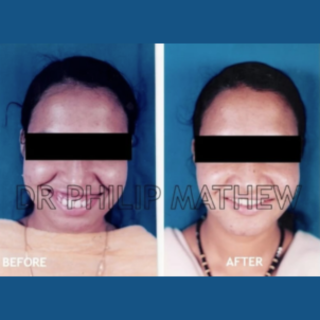 Jaw Contouring / Jaw Repair