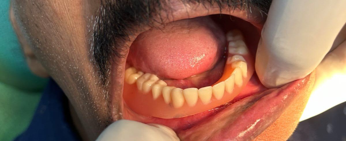 Dental Implants