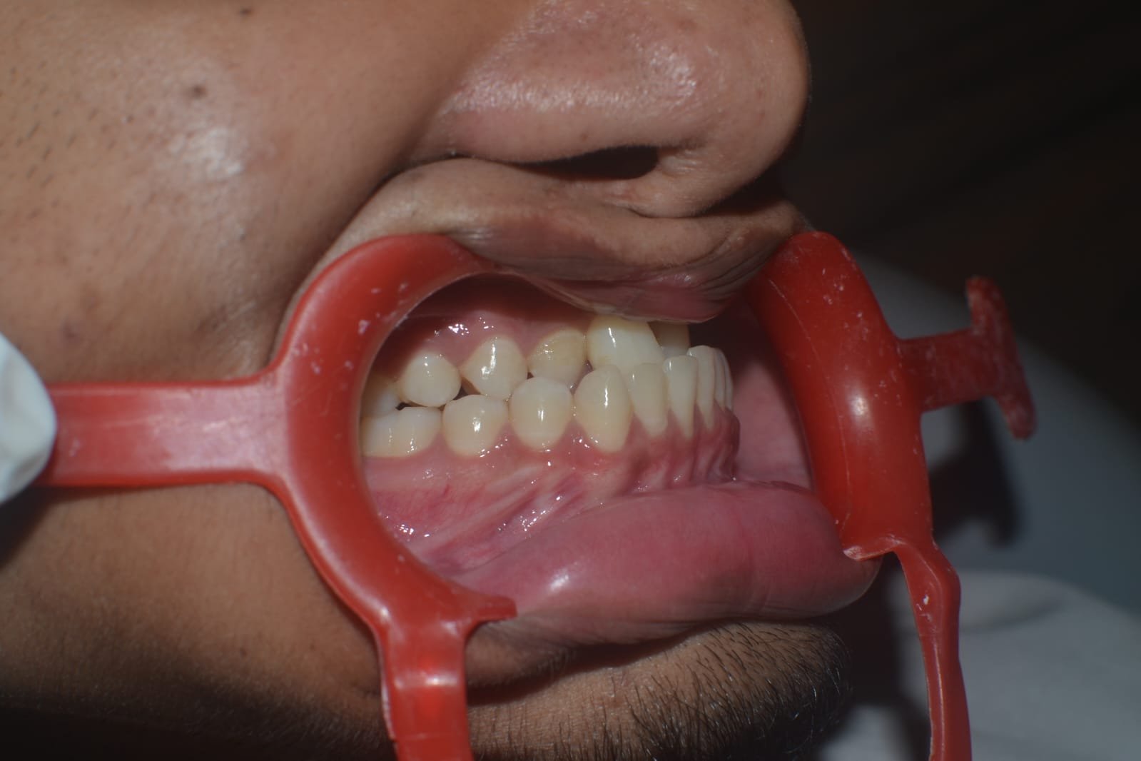 Mandibular Jaw Orthognathic Surgery