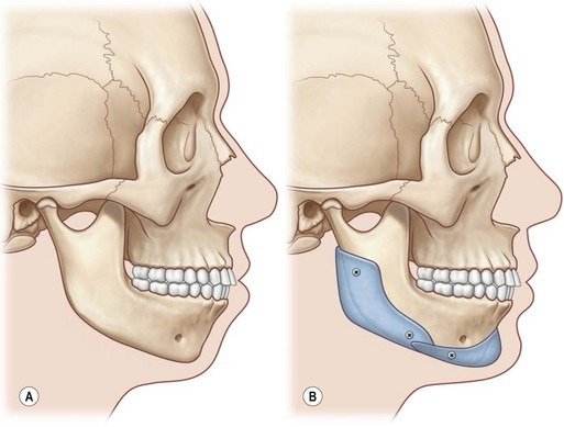 Deficient Chin