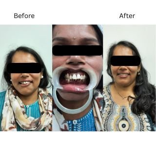 Smile Design