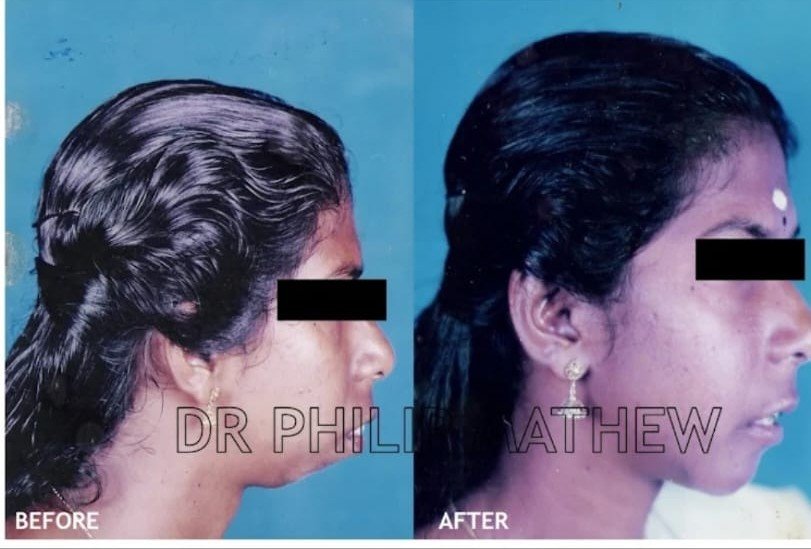 Genioplasty