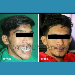 Orthognathic Surgery