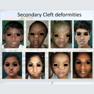 Cleft lip and Palate Treatment