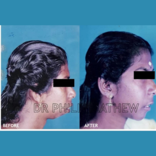 Orthognathic Surgery