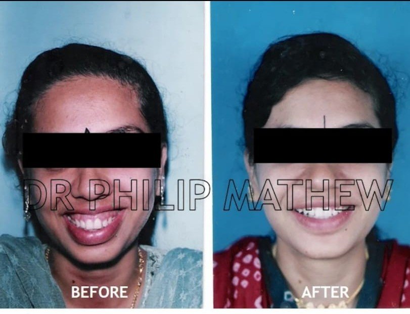 Orthognathic Surgery